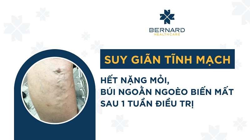 Hết nặng mỏi, búi ngoằn ngoèo biến mất chỉ sau 1 tuần điều trị